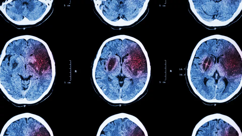 Röntgenbilder som visar förekomst av ischemisk stroke.
